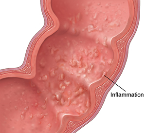 Cross section of colon showing ulcerative colitis.