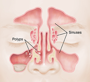 Front view of face showing sinuses with polyps.