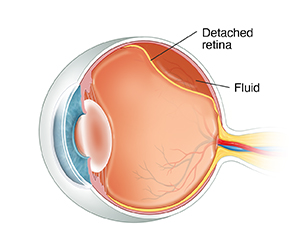Three-quarter view cross section of eye showing detatched retina.