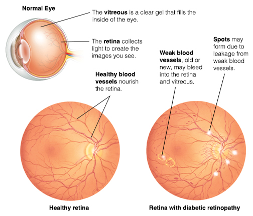 Cross section of eye showing vitreous and retina. Front view of healthy retina showing blood vessels. Front view of retina with diabetic retinopathy.