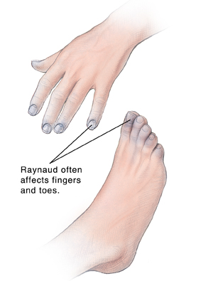 Hand and foot showing discolored tips of fingers and toes.