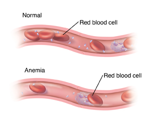 Cross section of blood vessel with normal amounts of red blood cells. Below it is another cross section of blood vessel showing too few red blood cells because of anemia.
