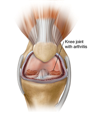 Front view of knee joint showing inflammation and arthritis.