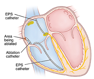 Cross section of heart showing catheters inserted into right atrium and ventricle for ablation procedure.