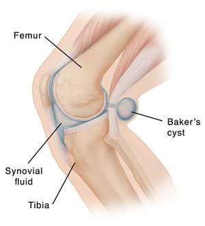 Side view of bent knee showing Baker's cyst.