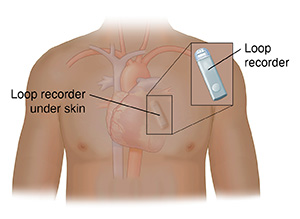 Front view of person's chest showing heart and loop recorder under skin with detail of loop recorder.