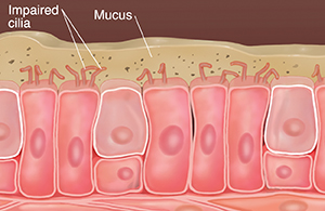 Cells with impaired cilia showing mucus buildup.