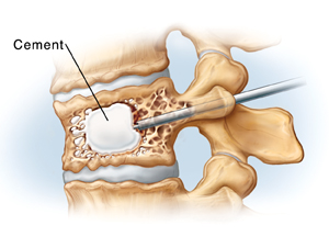 Side view of compressed vertebra and disks. Tube goes through back of vertebra into vertebral body and injects cement.