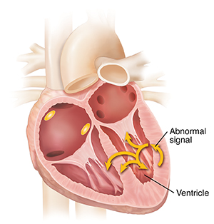 Cross section of heart showing location of abnormal signal in ventricle.