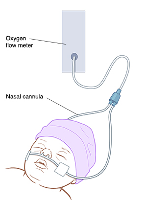 Closeup of baby's head with nasal cannula under nose.