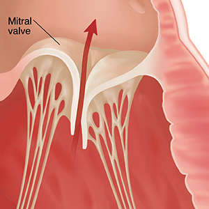 Close-up of mitral valve unable to close tightly arrow showing blood flowing backward.