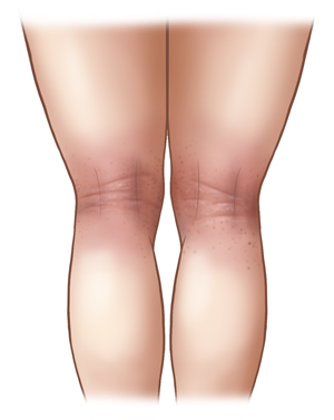 Back view of legs from showing eczema in the creases of the knees. 