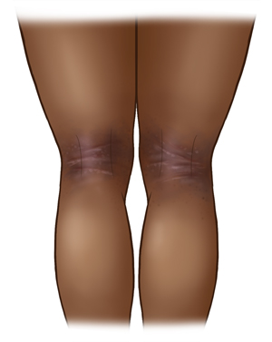 Back view of dark-skinned legs with eczema in the creases behind the knees.