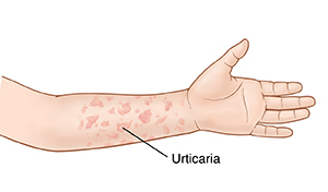 Mano y antebrazo con urticaria.