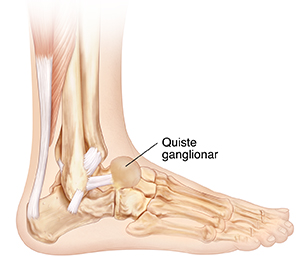 Vista lateral de los huesos de la parte inferior de la pierna y del pie donde se observa un quiste ganglionar.